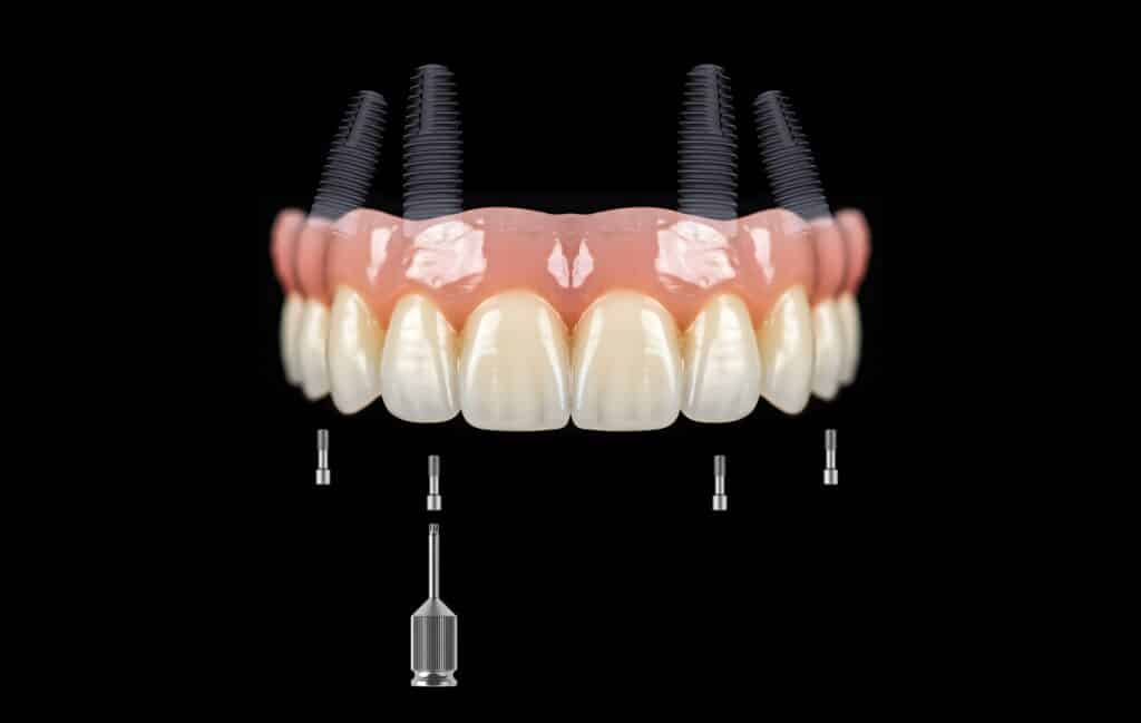 All-on-4 Dental Implants Magna & South Jordan